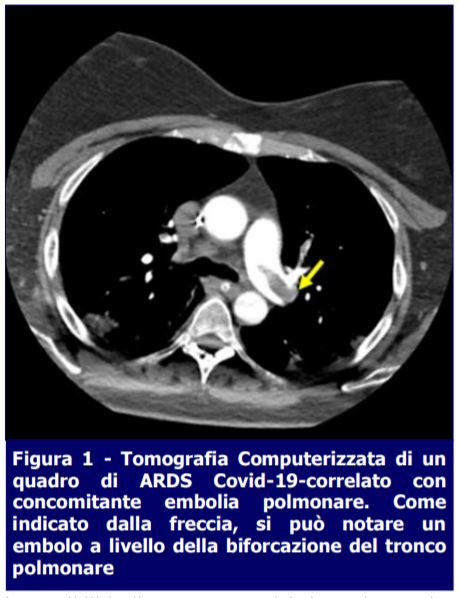 Tomografia Computerizzata-ARDS Covid19-ATI14 MEI